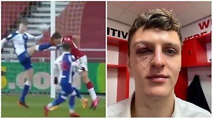 Για ένα χιλιοστό σώθηκε το μάτι παίκτη της Μίντλεσμπρο από βίαιο μαρκάρισμα