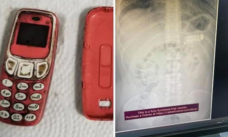 Τύπος κατάπιε ένα Nokia 3310, κόλλησε στο στομάχι του και χειρουργήθηκε