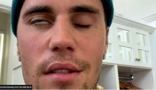 Τζάστιν Μπίμπερ: «Πάσχω από το σύνδρομο Ramsay Hunt – Παρέλυσε το μισό πρόσωπό μου»