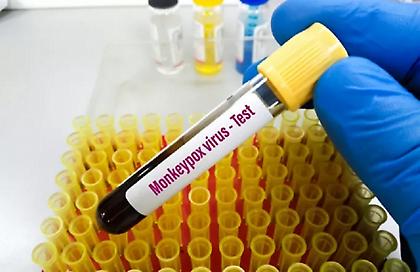 Ευλογιά των πιθήκων: Στα 82 τα επιβεβαιωμένα κρουσμάτα στην Ελλάδα