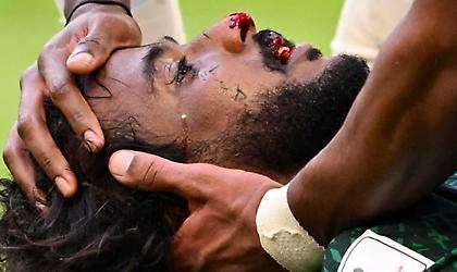 Κάταγμα γνάθου και οστών του προσώπου για τον Αλ-Σαχράνι - Σοκάρει η φωτογραφία!