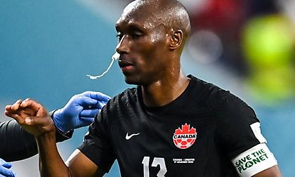 Ο Χάτσινσον σταμάτησε την αιμορραγία στη μύτη με... ταμπόν!