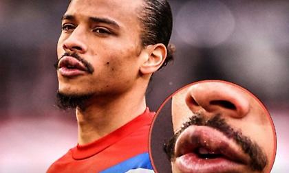 Ο Σανέ εμφανίστηκε με πρησμένο χείλος τέσσερις ημέρες μετά την γροθιά του Μανέ!