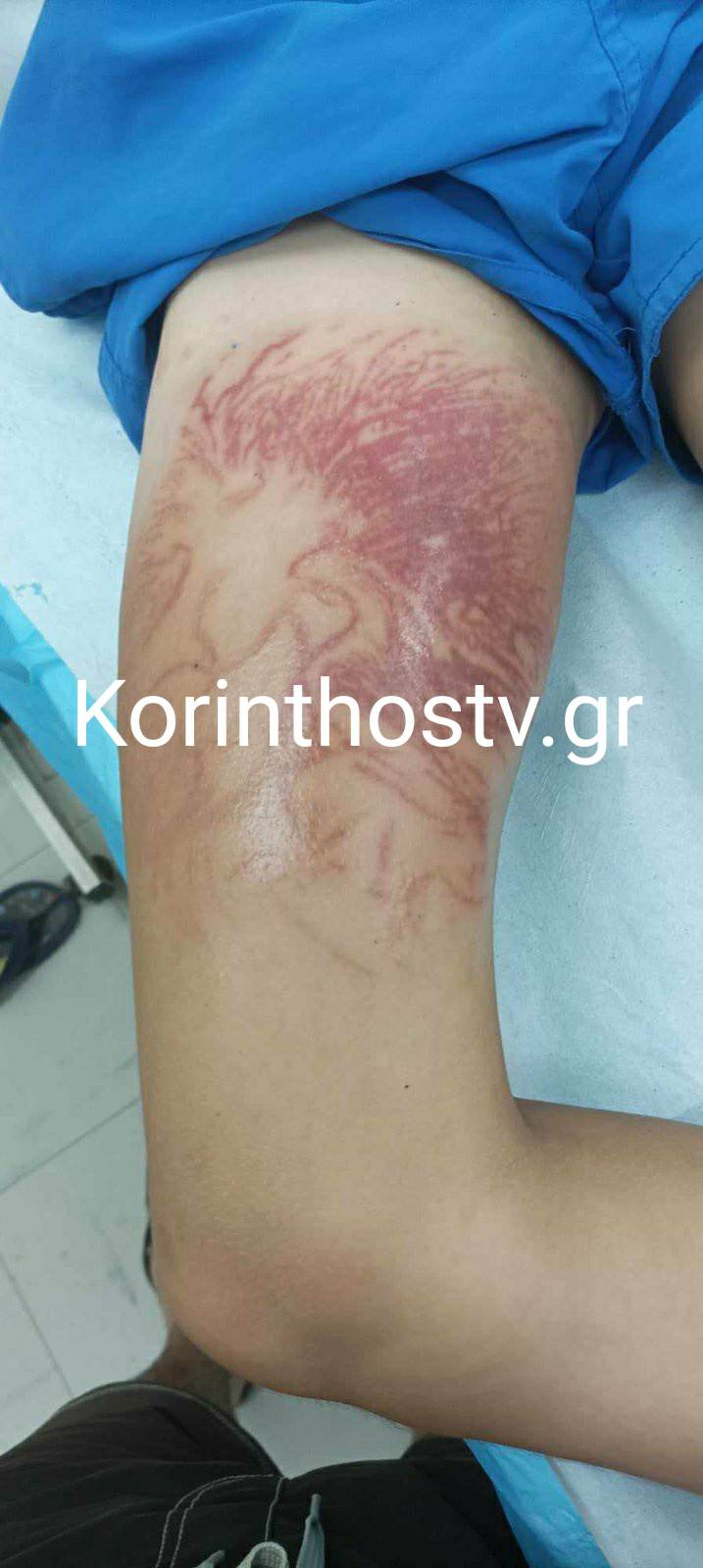Θαλάσσια ανεμώνη: Στο νοσοκομείο 9χρονος από τσίμπημα
