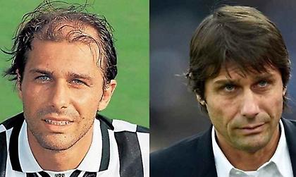 «Ποτέ δεν έβαλα περούκα»: Ο Κόντε μίλησε για την εμφύτευση μαλλιών