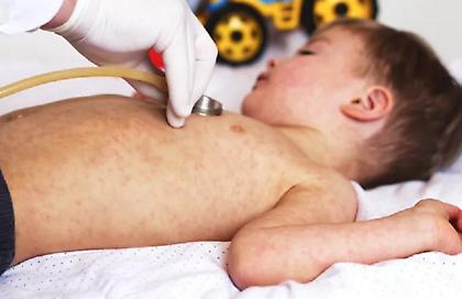 Συναγερμός στη Βρετανία από τη ραγδαία αύξηση των κρουσμάτων ιλαράς