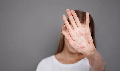 Σε επαγρύπνηση ο ΕΟΔΥ για την αντιμετώπιση ενός πιθανού επιδημικού κύματος ιλαράς