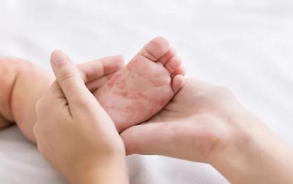 Ινστιτούτο Παστέρ: Ανοδική τάση παρουσιάζει η ιλαρά - Στοιχεία για την κατάσταση στην Ελλάδα