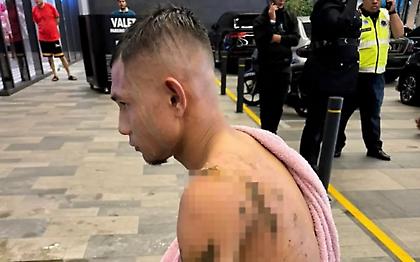 Στην εντατική Μαλαισιανός διεθνής ποδοσφαιριστής μετά από επίθεση με καυστικό οξύ!