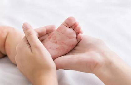 Καμπανάκι από ΠΟΥ λόγω της ραγδαίας αύξησης των κρουσμάτων ιλαράς στην Ευρώπη!