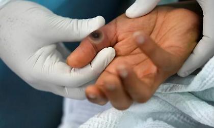 Ανησυχία για την εξάπλωση της ευλογιάς τον πιθήκων στην Ευρώπη: Το CDC αύξησε το επίπεδο συναγερμού