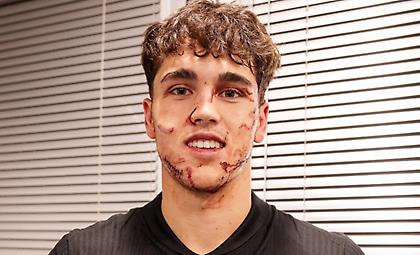 «Χρειάζεται δέκα ράμματα»: Σοκαριστική η εικόνα του Κουμπαρσί μετά την κλοτσιά που δέχτηκε στο πρόσωπο