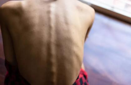 Στη φυλακή γονείς μπαλαρίνας - Η κόρης τους ζύγιζε 27 κιλά στα 17 της