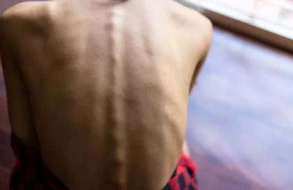 Στη φυλακή γονείς μπαλαρίνας - Η κόρης τους ζύγιζε 27 κιλά στα 17 της