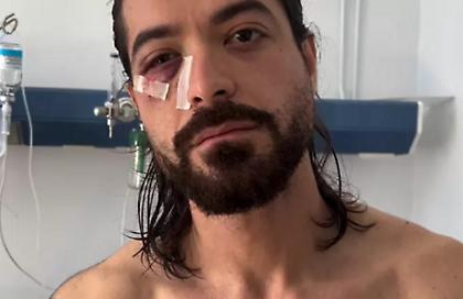 Οι πρώτες δηλώσεις του Άρη Μουγκοπέτρου από το νοσοκομείο: «Νόμιζα πως η κροτίδα ήταν καπνογόνο»