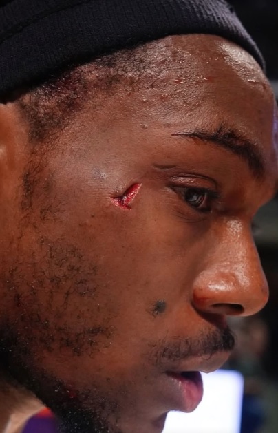 Το βαθύ σχίσιμο στο πρόσωπο του Πέρι από το αντιαθλητικό που έκρινε το Μάλαγα-Ρεάλ