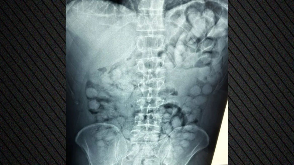 Είχε καταπιεί 100 συσκευασίες κοκαΐνης - Συνελήφθη στο «Ελ. Βενιζέλος»