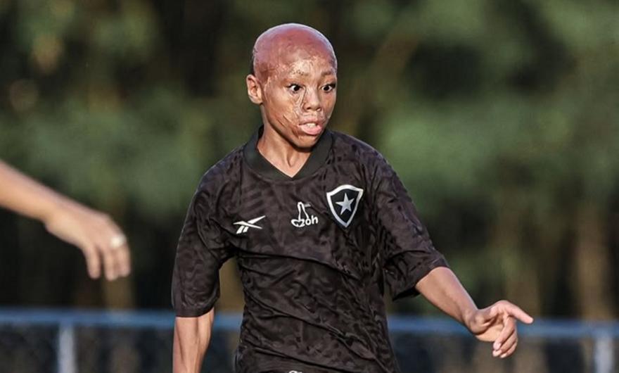 Μπερνάρντο, το παιδί-θαύμα της Μποταφόγκο που επέζησε από βαριά εγκαύματα και διαπρέπει