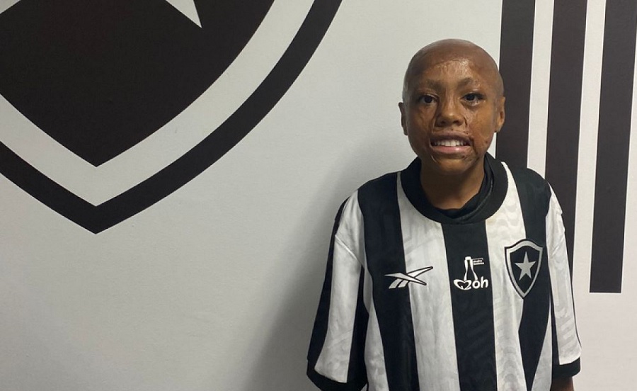 Μπερνάρντο, το παιδί-θαύμα της Μποταφόγκο που επέζησε από βαριά εγκαύματα και διαπρέπει