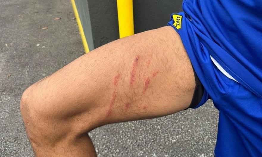 Η σκαριά στο πόδι του Ρόουζ από το μαρκάρισμα του Ιβανούσετς (pic)