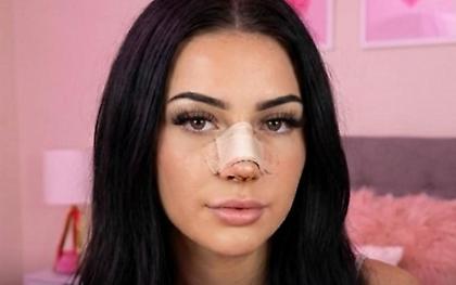 Μοντέλο άλλαξε μύτη για να μην... κληρονομήσουν τα παιδιά της την άσχημη που είχε