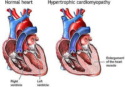 Υπερτροφική καρδιομυοπάθεια και θάνατοι αθλητών